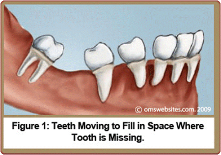  Bite misalignment, malposition of teeth