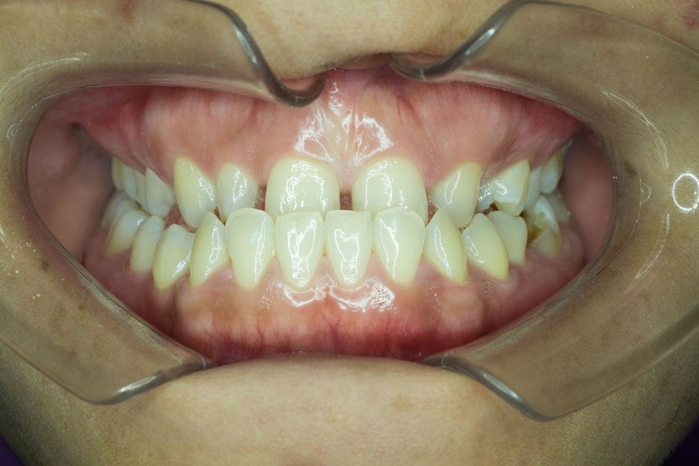 What is two-jaw surgery? 