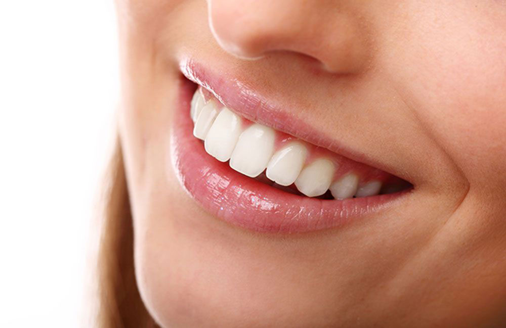 How many types of Porcelain veneers are there?
