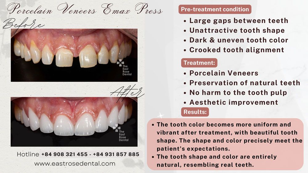 A case of Porcelain Veneer at The East Rose Dental Clinic: