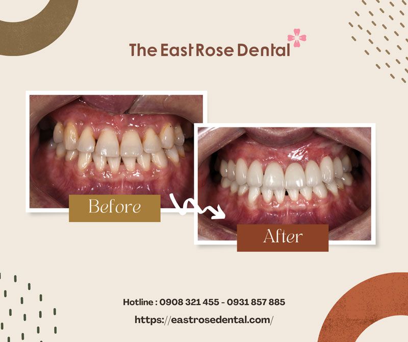 Veneer cases performed by The East Rose Dental Clinic