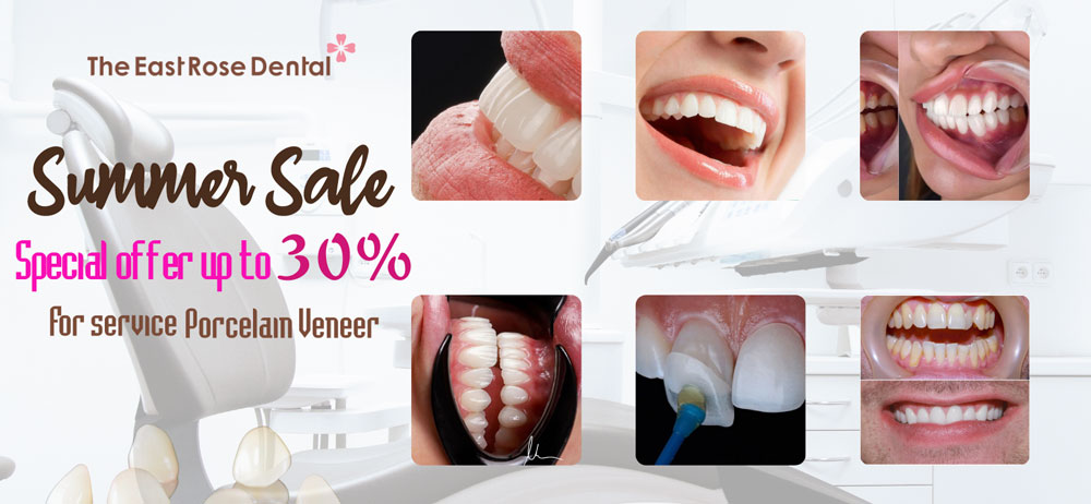Special offer up to 30% off Porcelain Veneer at Rose Dental Clinic HCMC