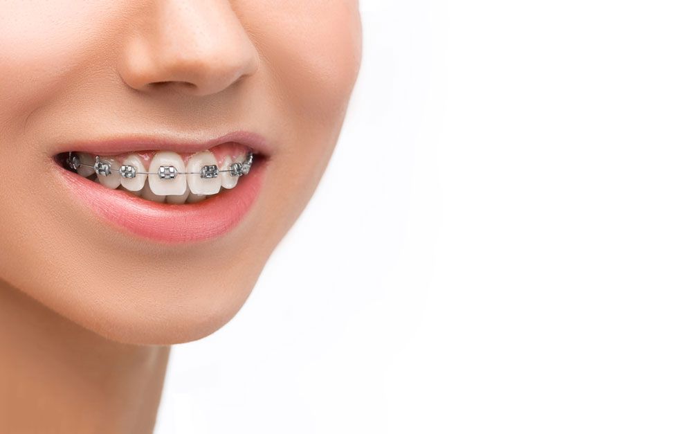 Braces bring you a beautiful, confident smile, and overcome many shortcomings