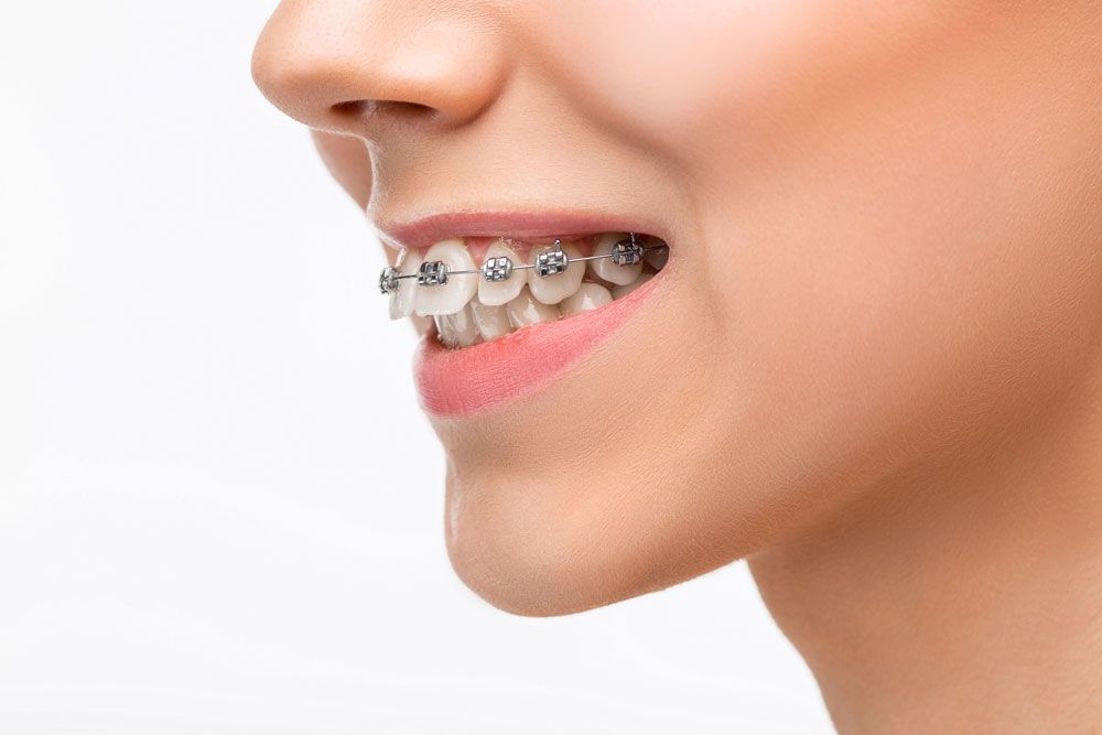 Braces with brackets based on the pulling force of the arch wire and brackets to adjust teeth
