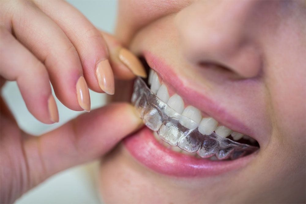 Invisalign method does not use metal brackets and wires