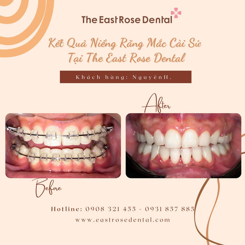 case braces with brackets at The East Rose Dental