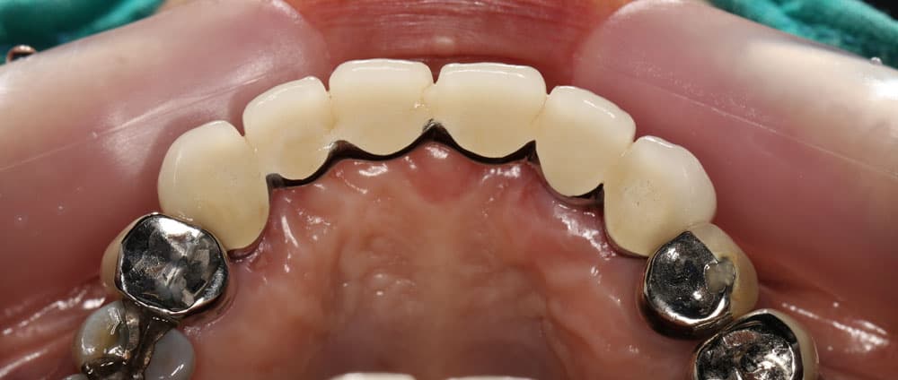 Porcelain teeth with metal ribs have a relatively high durability of about 5-7 years