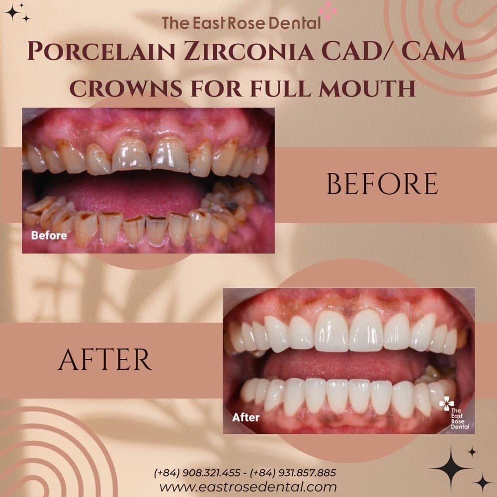 Case Porcelain Crown at East Rose Dental 