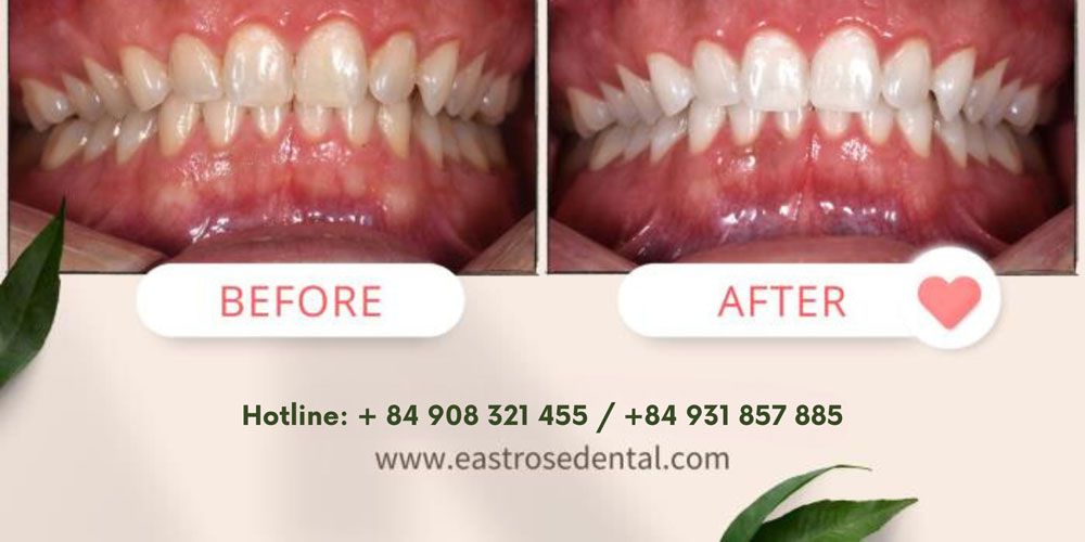 East Rose Dental - The first choice for teeth whitening