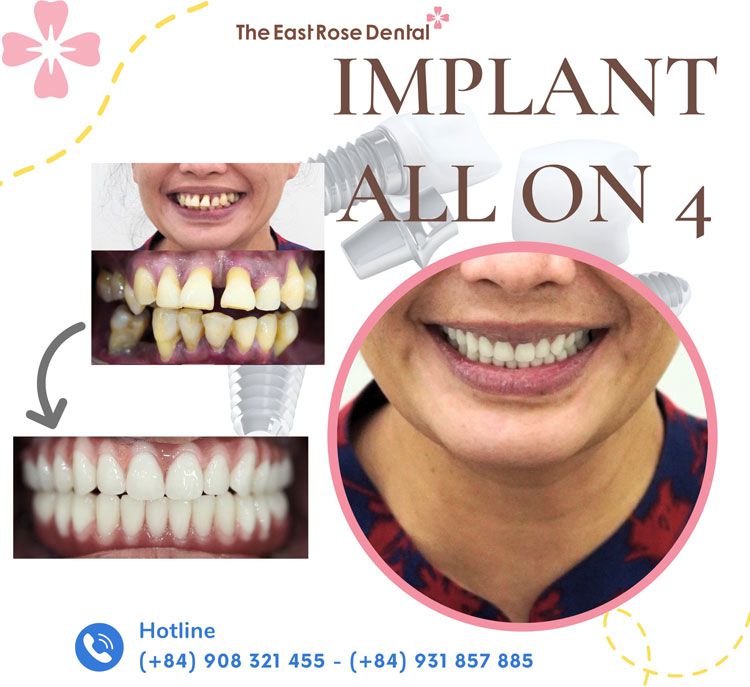 case implant on all 4 at The East Rose Dental