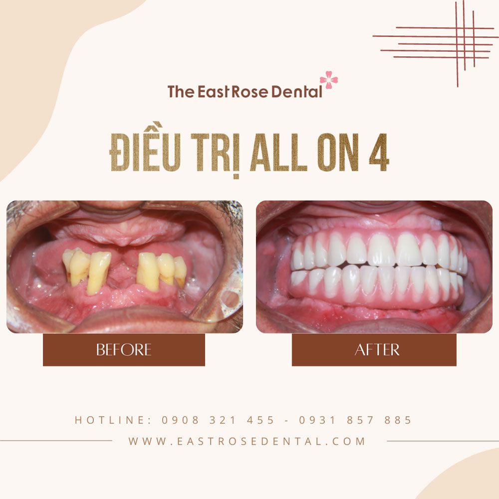 case implant on all 4 at The East Rose Dental