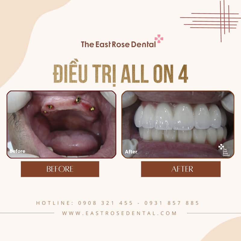 All On 4 Full Jaws Treatment Process At The East Rose Dental Clinic