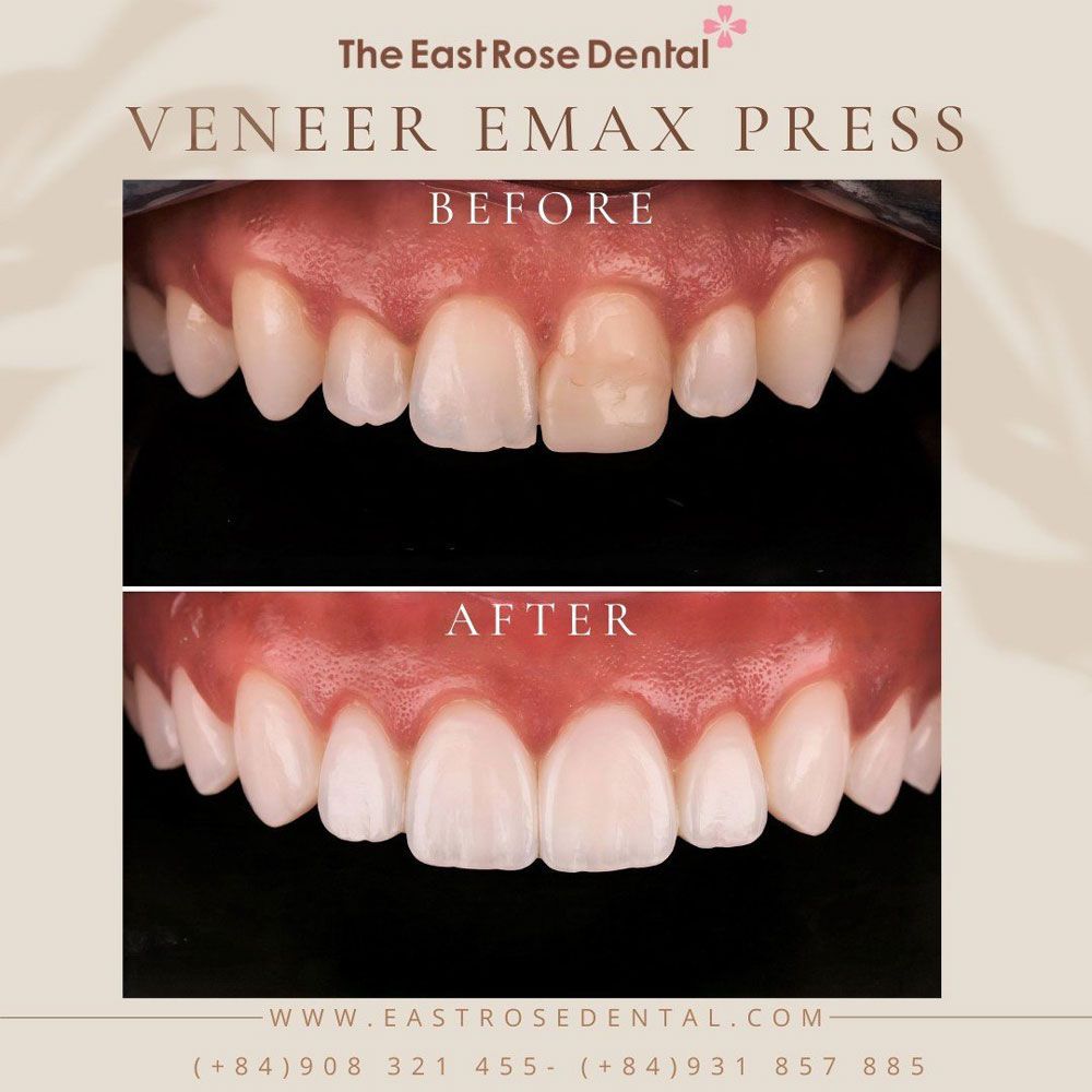 Case Veneer Emax Press at East Rose Dental Clinic