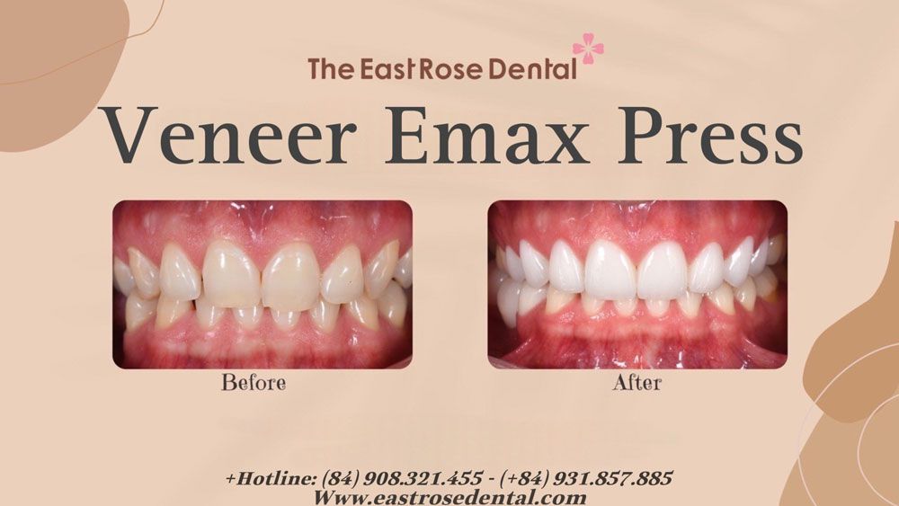 Case Veneer Emax Press at East Rose Dental Clinic
