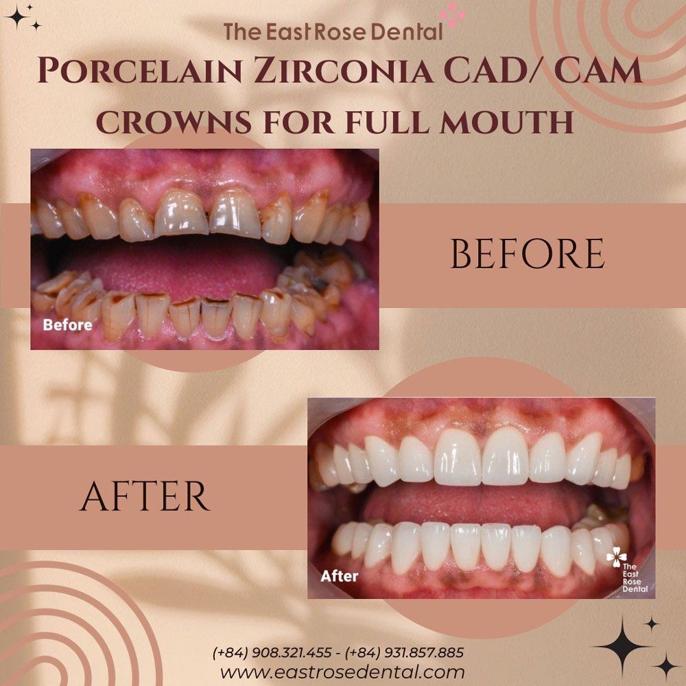 Case Porcelain Crown at The East Rose Dental Clinic
