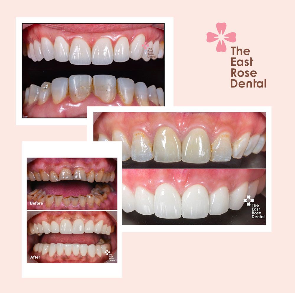 3 Porcelain Veneer cases for both jaws just completed