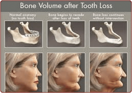 Bone loss