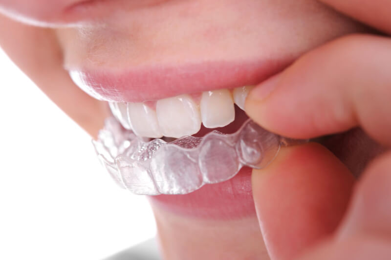 Tìm hiểu về phương pháp niềng răng có mắc cài và niềng răng không mắc cài 