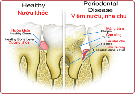  Inflammation of the gums and surrounding structures