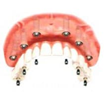lost all teeth on 1 arch op3