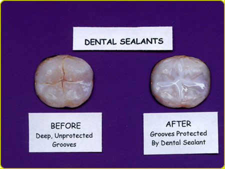 before and after applying sealants 