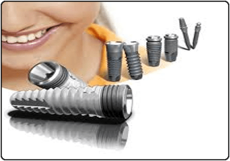can the body reject a dental implant