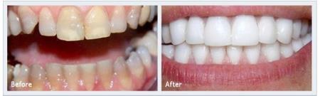 Tetracycline stained teeth treated with pure Zirconia crowns case 1