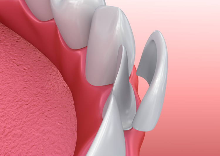 dental veneers overview