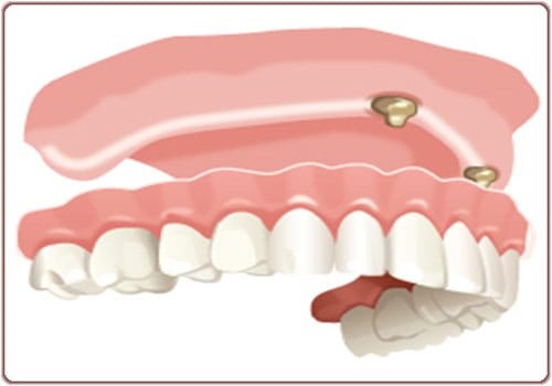 Full implant-supported denture