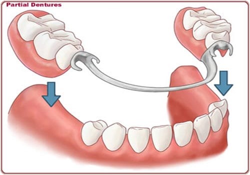 Partial removable denture