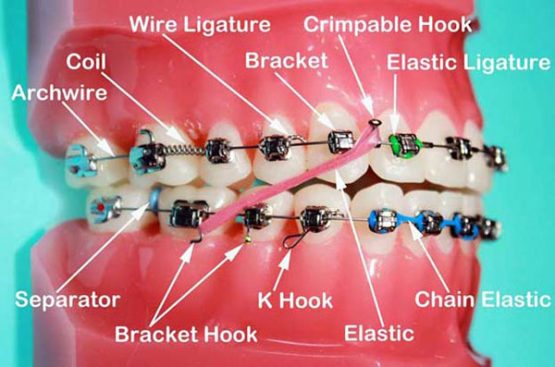 braces component