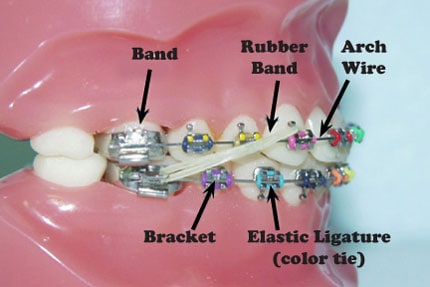braces parts