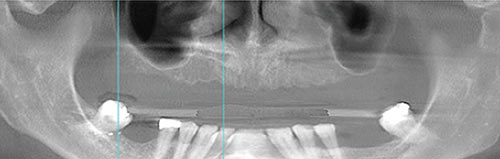 Patient has large sinus spaces and not enough bone to spread the implants sufficiently for a full complement of teeth