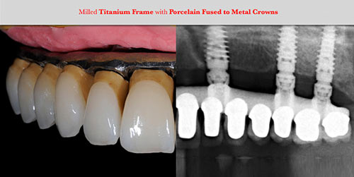 Titanium Zirconia solutions Rose Dental Clinic 2