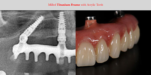 Titanium Zirconia solutions Rose Dental Clinic 3