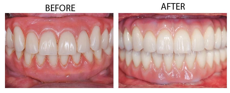 Titanium Zirconia solutions Rose Dental Clinic 4