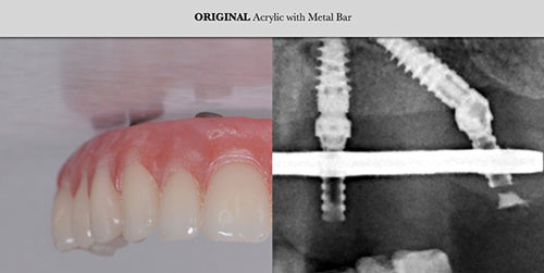 Titanium Zirconia solutions Rose Dental Clinic 1