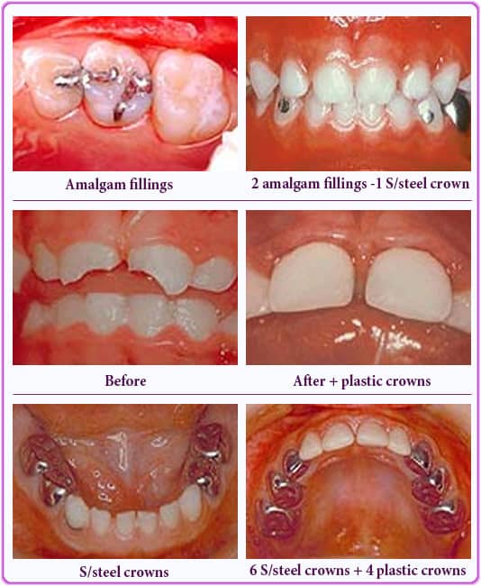 best way of restoring decayed baby tooth