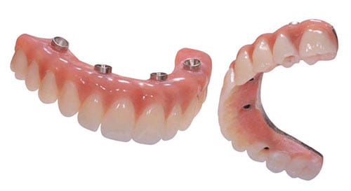Your immediate teeth with high impact acrylic