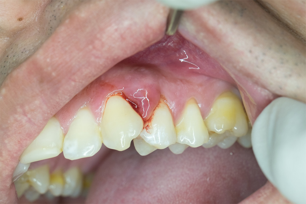5 Important Symptoms of Gum Disease