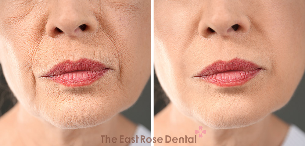 Prevent facial sagging and wrinkles around the nose and mouth