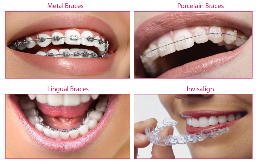 There are 4 types of Braces on the market today