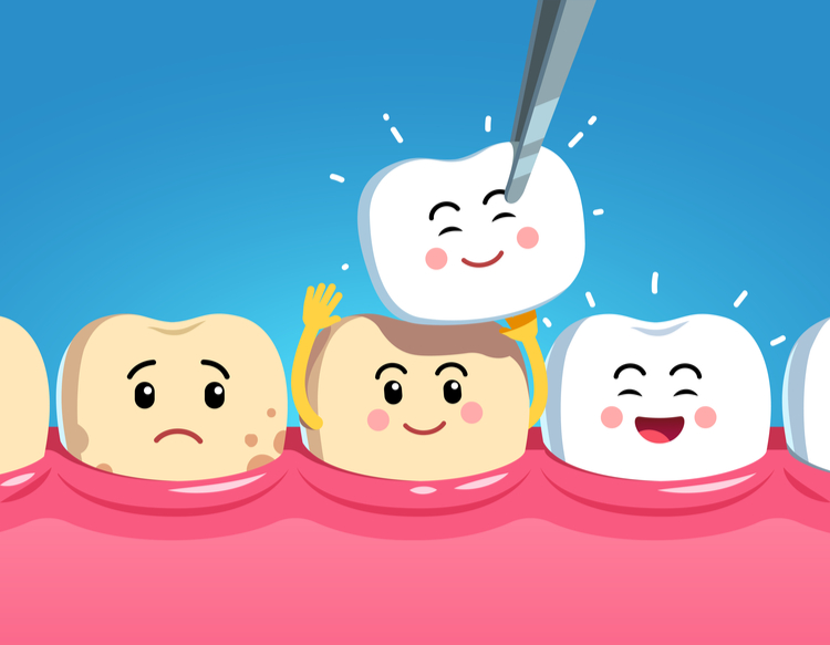 benefit of dental veneers