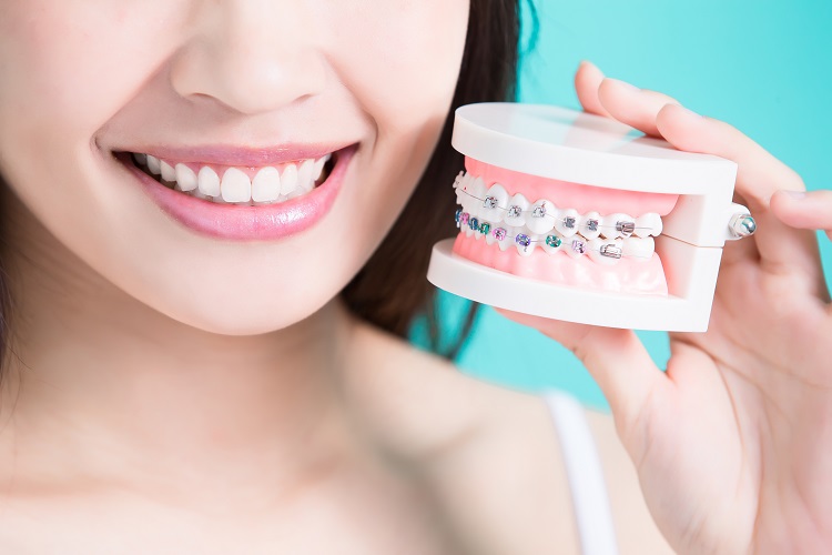 braces for misaligned teeth