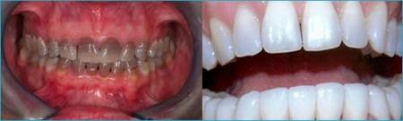 Tetracycline stained teeth treated with pure Zirconia crowns case 2