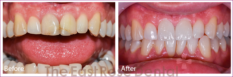 2 front teeth restorations for hot English teacher