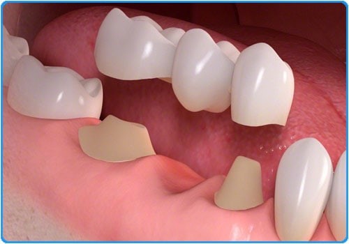 quá trình làm cầu răng