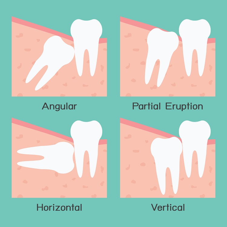 causes of impacted wisdom teeth