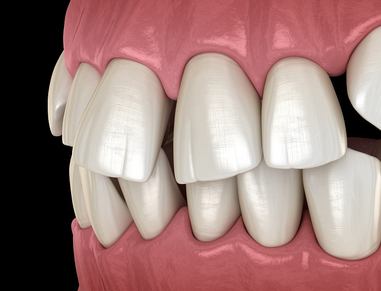 misaligned front teeth
