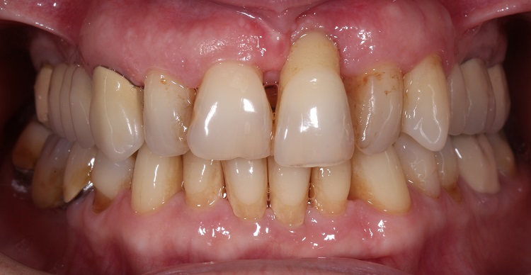 periodontitis teeth